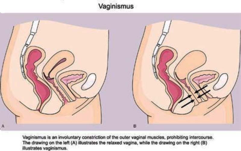 Vaginismus - Dr A CHAKRAVARTHY